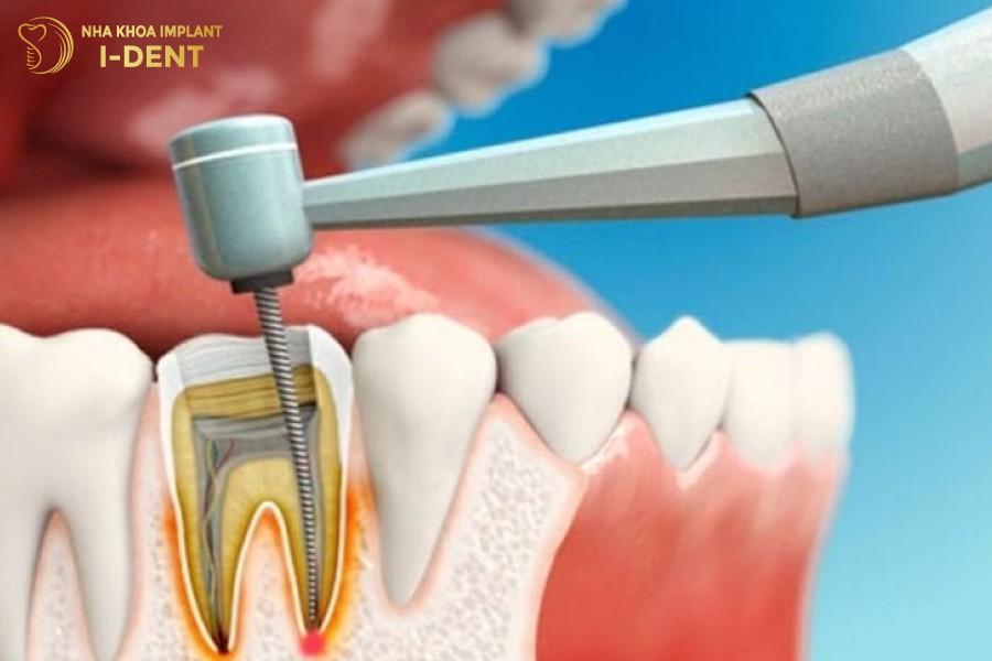 Rang-nhieu-ong-tuy-phai-chua-tuy-lan-2-lan-3