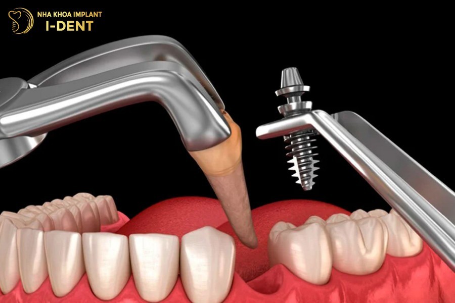 Rang-sau-nang-khong-the-phuc-hoi-thi-nen-nho-va-cay-ghep-Implant