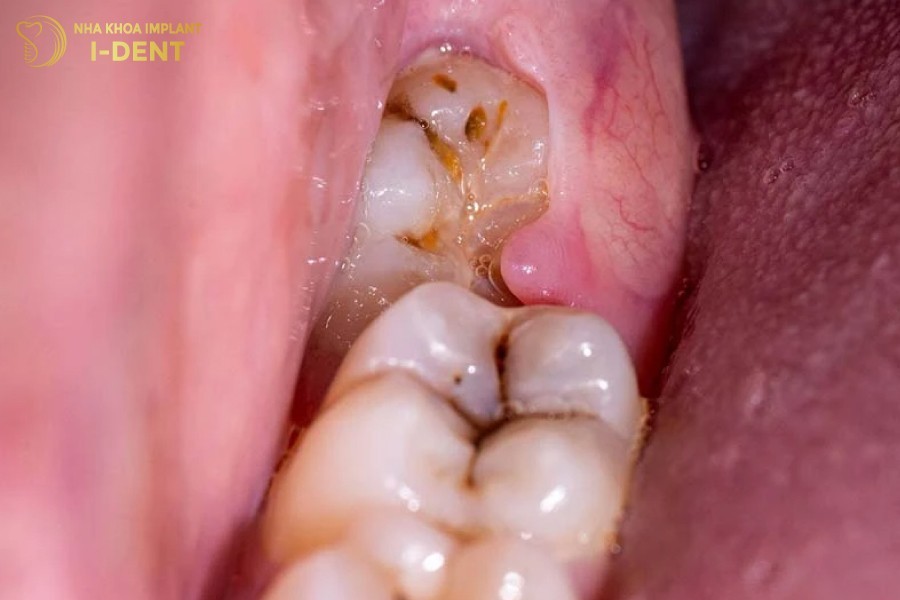 Rang-so-8-bi-sau-gay-dau-nhuc-kho-chiu