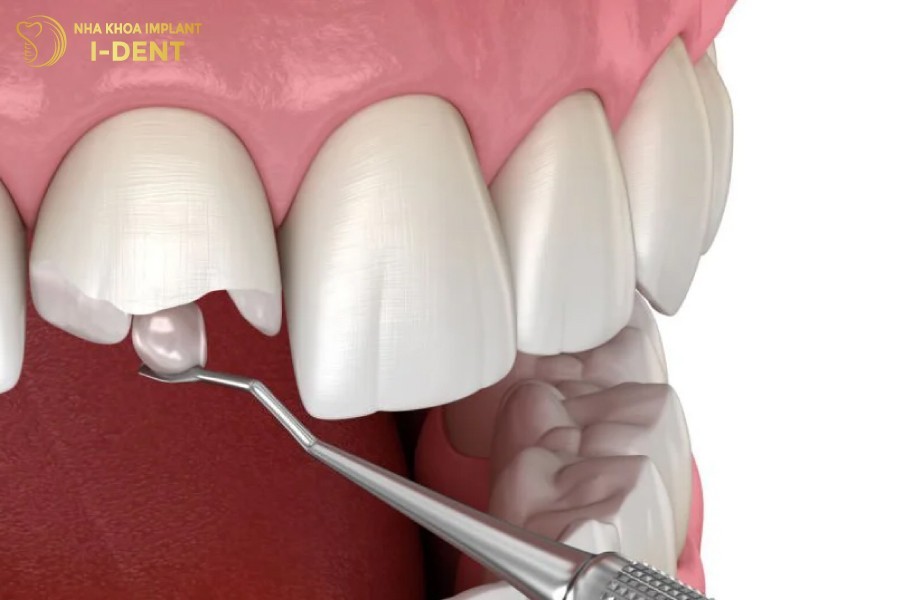 Trám răng tại nhà không đảm bảo vô trùng