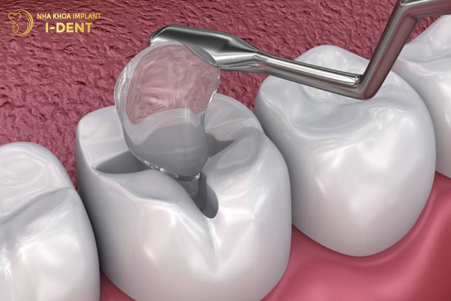 Sau-khi-tram-rang-van-co-the-bi-sau-tro-lai.