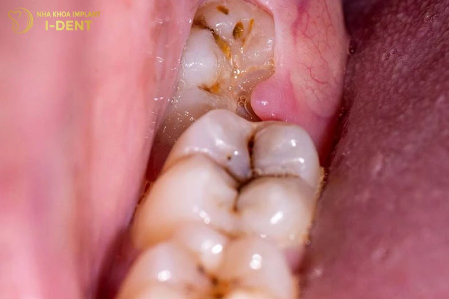 Sau-rang-la-mot-trong-nhung-nguyen-nhan-hang-dau-gay-viem-tuy