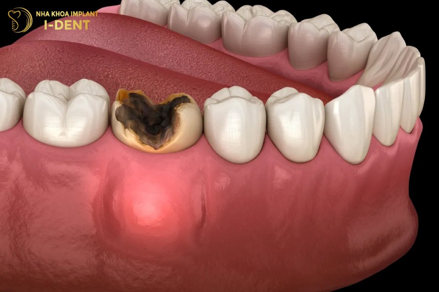 Sau-rang-nang-gay-viem-tuy-rang-thi-phai-tien-hanh-chua-tuy