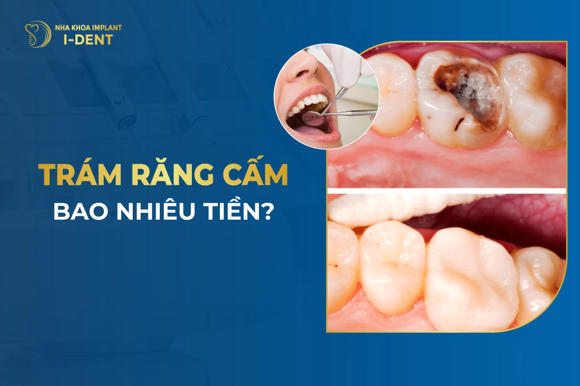 Trám Răng Cấm Bao Nhiêu Tiền?