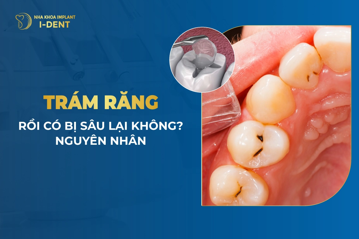 Trám Răng Rồi Có Bị Sâu Lại Không? Nguyên Nhân