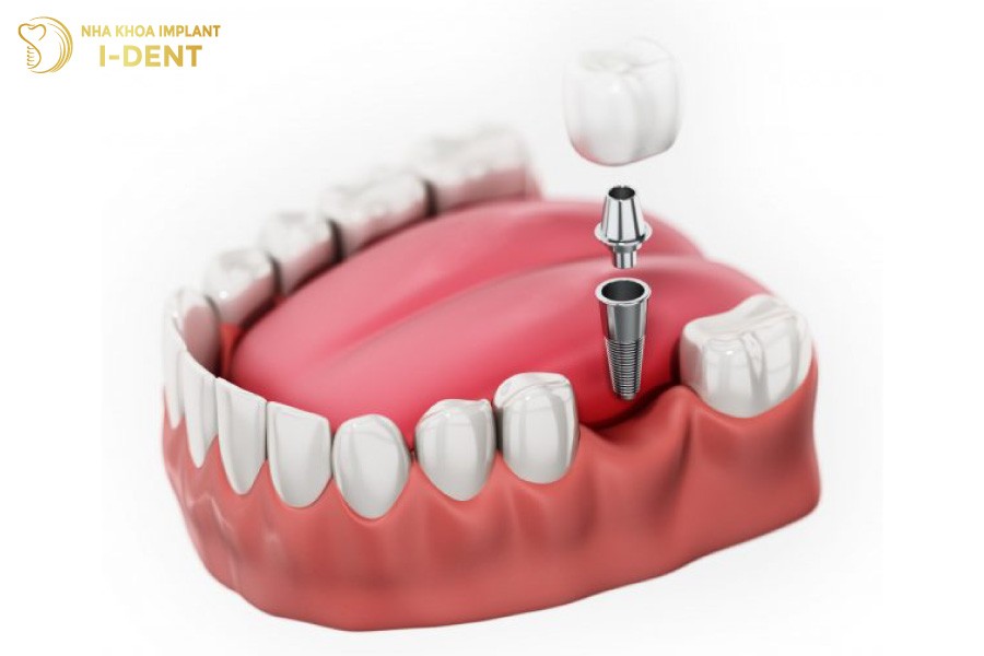 Trong-rang-ngay-sau-khi-nho-rang-so-7