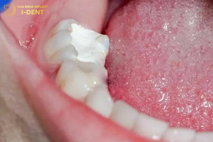 Vat-lieu-kem-chat-luong-khien-cho-mieng-tram-rang-de-nut-vo