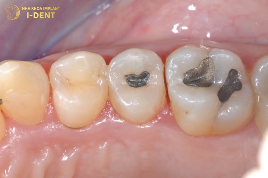 Ve-sinh-rang-khong-ky-luong-dan-toi-sau-rang-tai-phat-nhanh-chong.