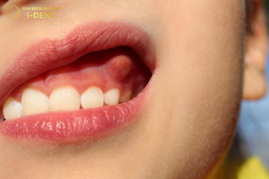 Viem-tuy-co-the-dan-toi-ap-xe-chan-rang-rat-nguy-hiem