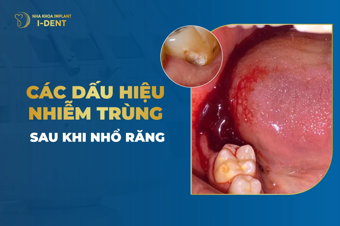 10 dấu hiệu nhiễm trùng sau khi nhổ răng và cách điều trị