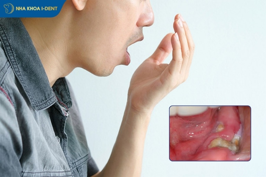 các triệu chứng sau khi nhổ răng