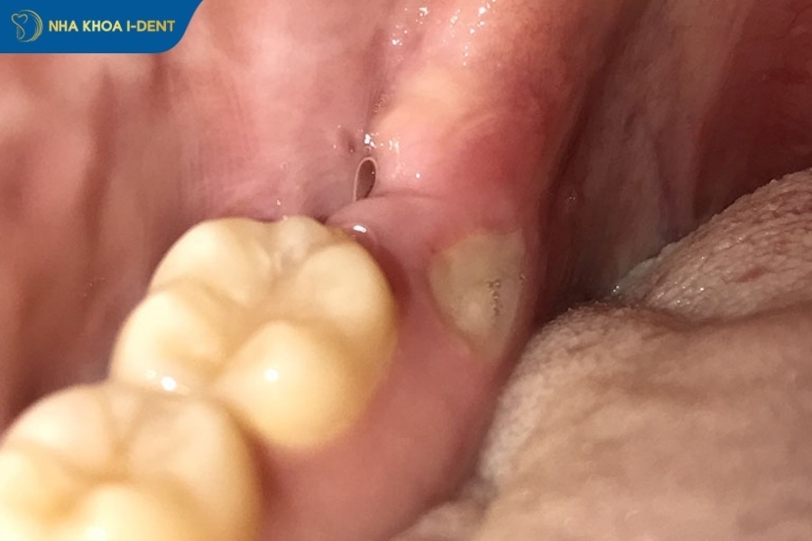 đau nhức sau khi nhổ răng khôn