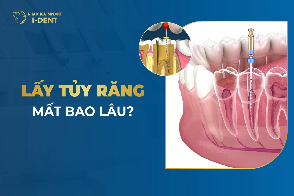 Chữa Tủy Răng Mất Bao Lâu? Phụ Thuộc Những Yếu Tố Nào?