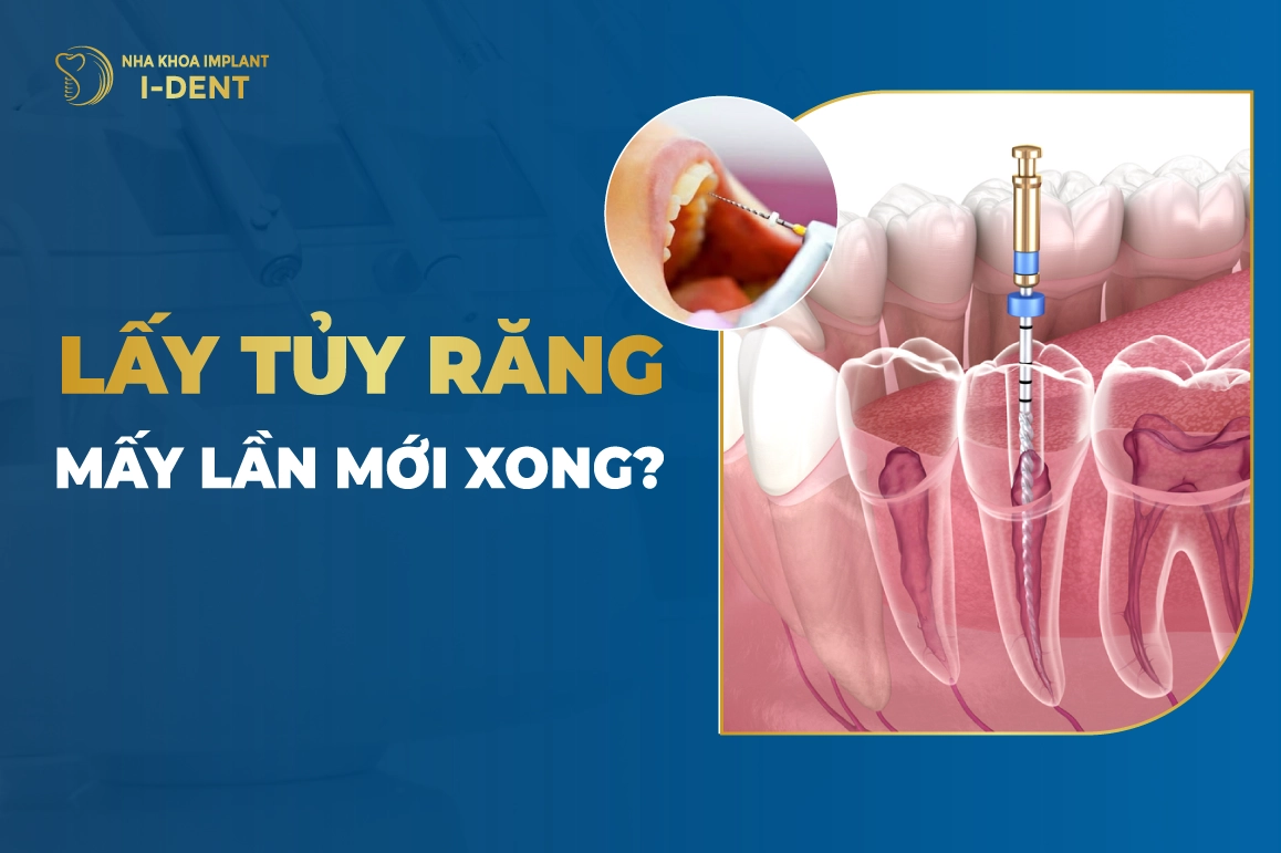 Lấy Tủy Răng Mấy Lần Mới Xong?