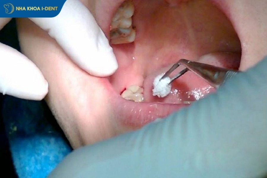 Nhiễm trùng sau khi nhổ răng khôn