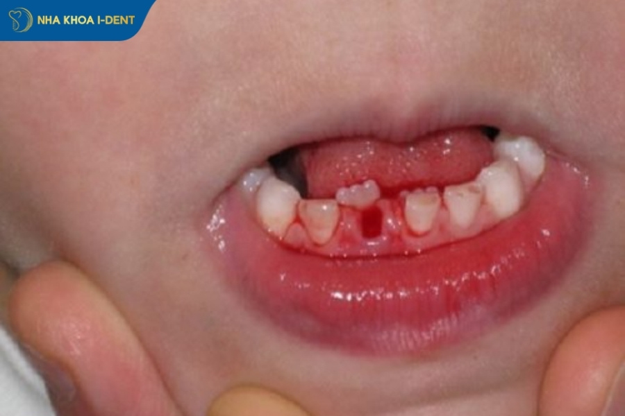 nhổ răng có ảnh hưởng gì đến sức khỏe