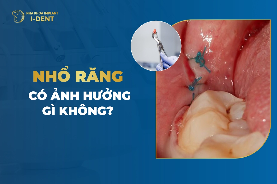 Nhổ răng có ảnh hưởng gì không? Biến chứng có thể gặp