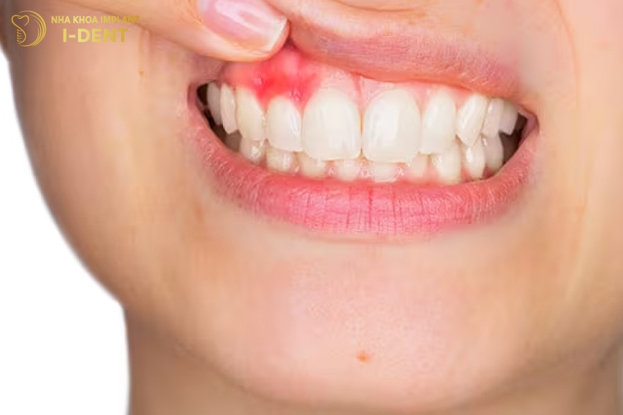 nuou-sung-dau-sau-khi-lay-tuy-rang