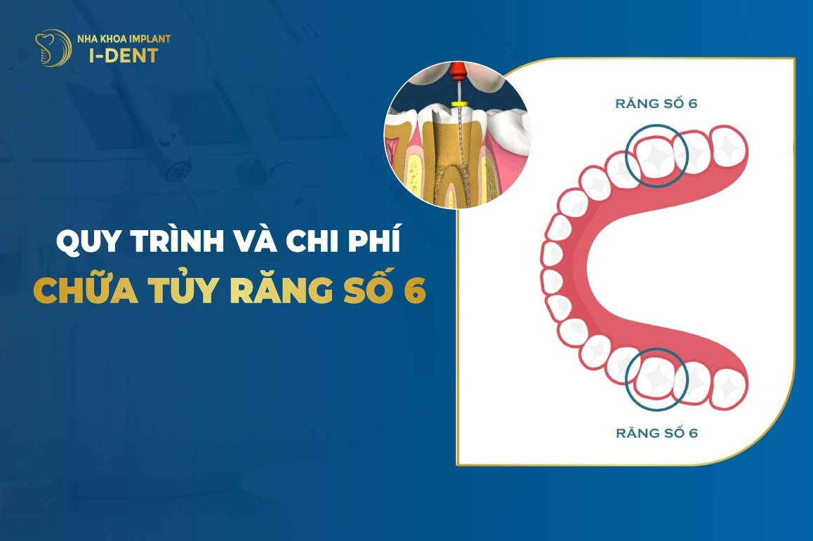Quy Trình Và Chi Phí Chữa Tủy Răng Số 6