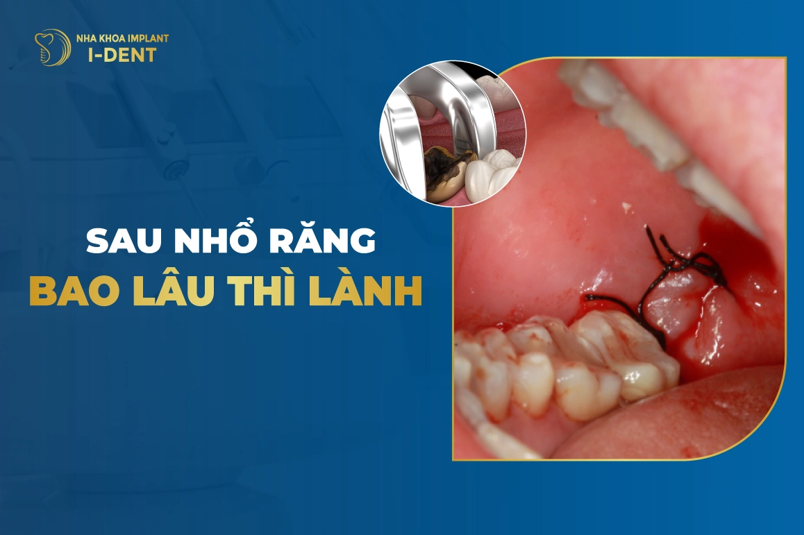 Sau Nhổ Răng Bao Lâu Thì Lành?