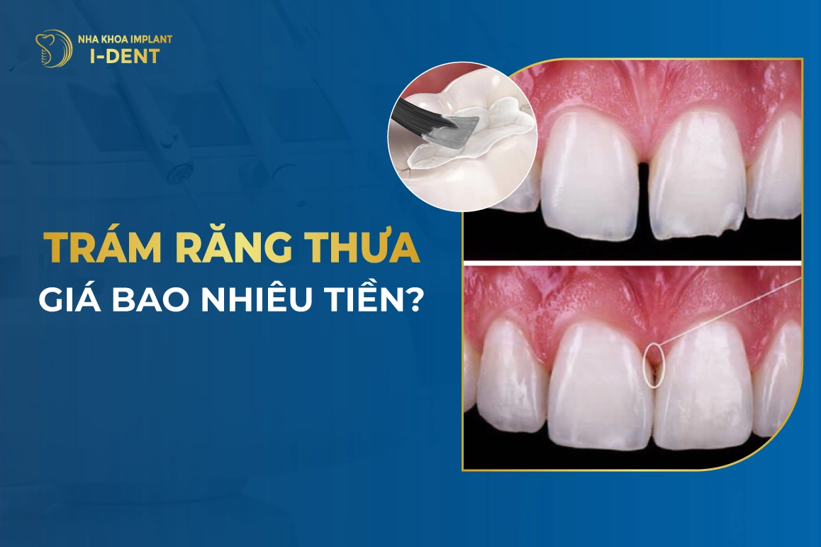 Trám Răng Thưa Giá Bao Nhiêu Tiền?