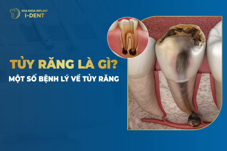 Tủy Răng Là Gì? Một Số Bệnh Lý Về Tủy Răng