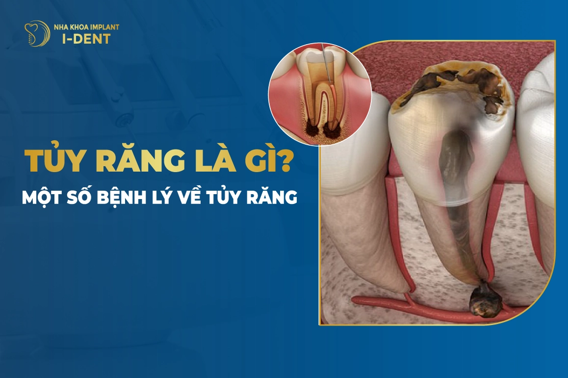 Tủy Răng Là Gì? Một Số Bệnh Lý Về Tủy Răng