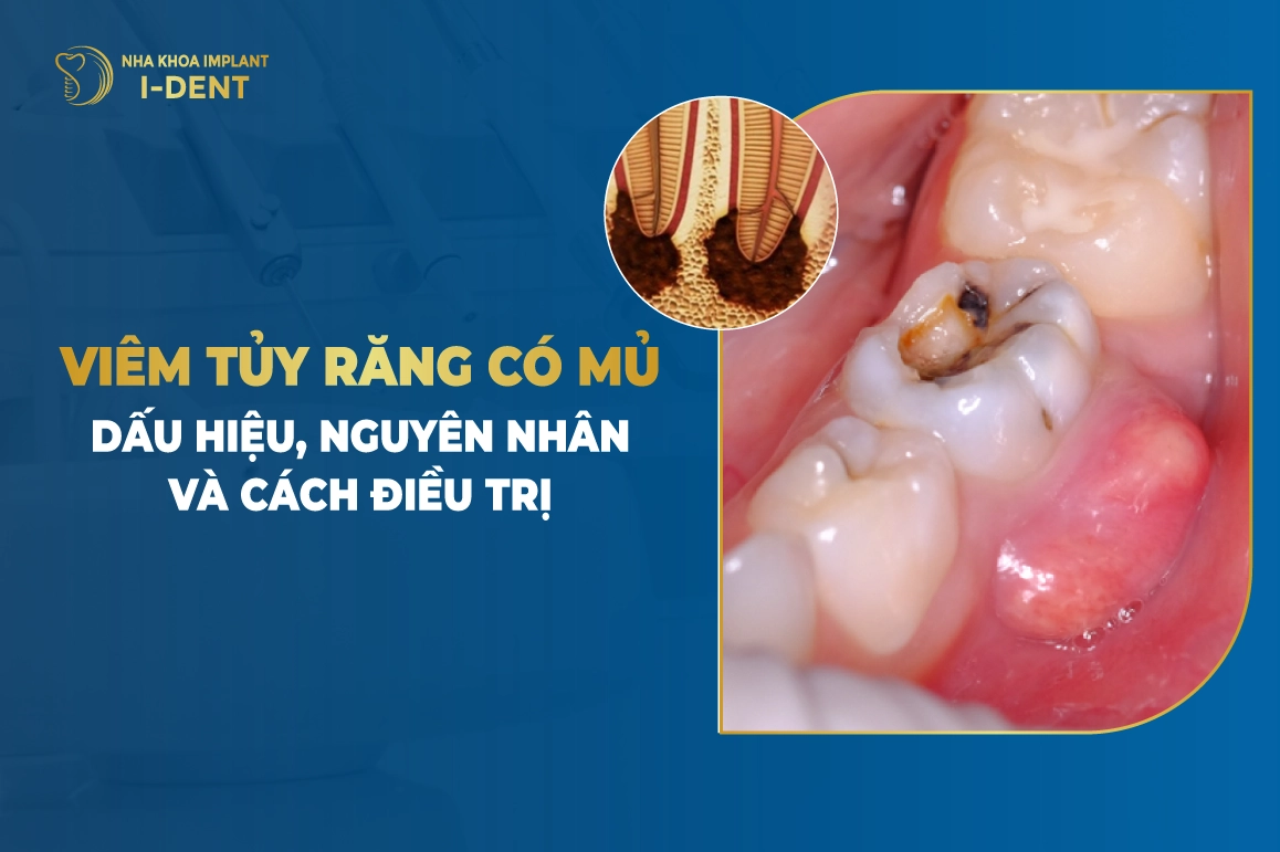 Viêm Tủy Răng Có Mủ: Dấu Hiệu, Nguyên Nhân Và Cách Điều Trị