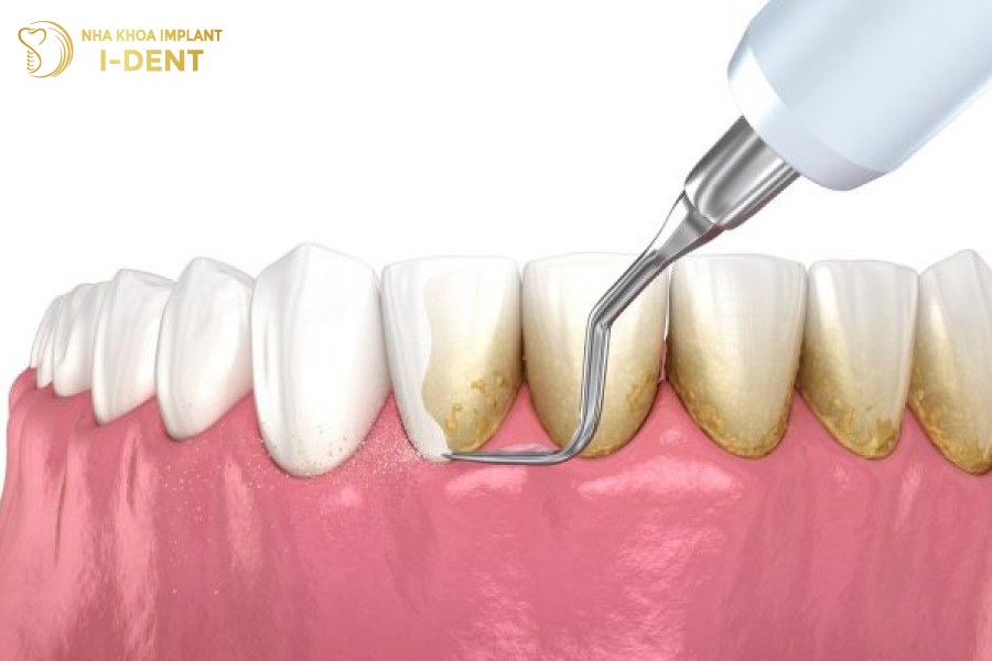 Cao-voi-rang-khong-giup-rang-trang-sang-bat-tone