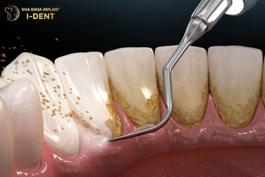 Cao-voi-rang-tai-nha-khong-dam-bao-hieu-qua-nhu-o-nha-khoa