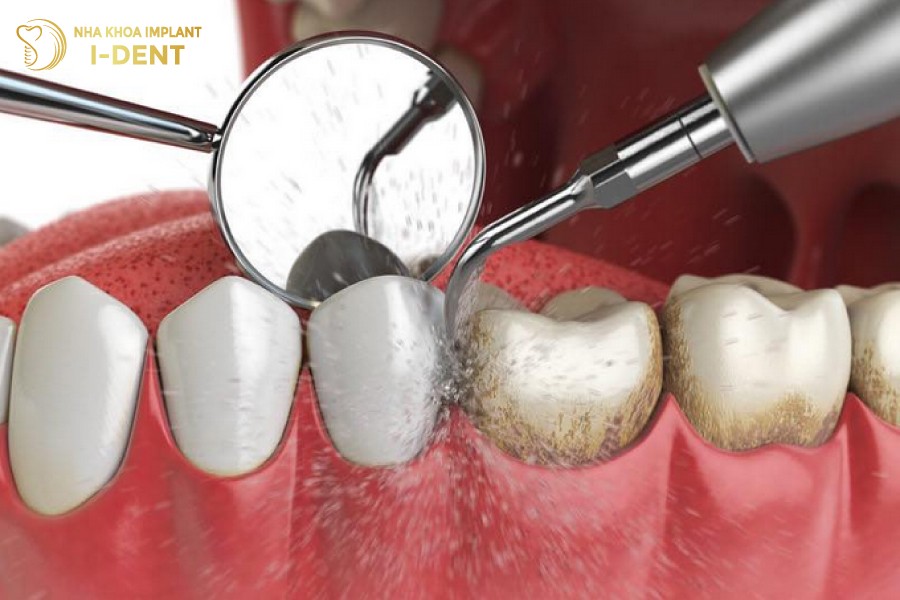 Chi-nen-cao-voi-rang-2-lan-nam-khong-nen-lam-dung-qua-nhieu