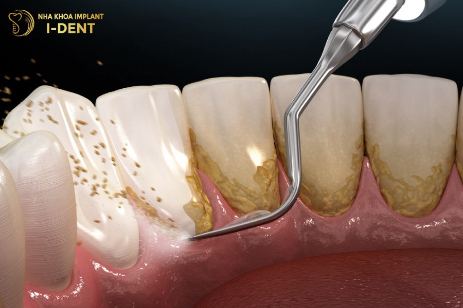 Cong-nghe-song-sieu-am-giup-lam-sach-voi-rang-de-dang-va-nhanh-chong