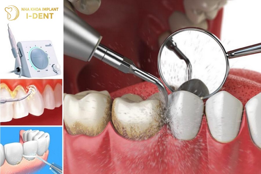 Voi-rang-chi-co-the-duoc-loai-bo-bang-cac-ky-thuat-nha-khoa