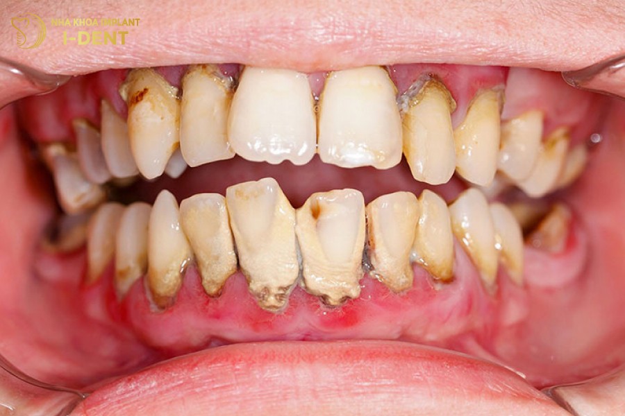 Voi-rang-tich-tu-lau-ngay-gay-ra-nhieu-benh-ly-rang-mieng-nguy-hiem