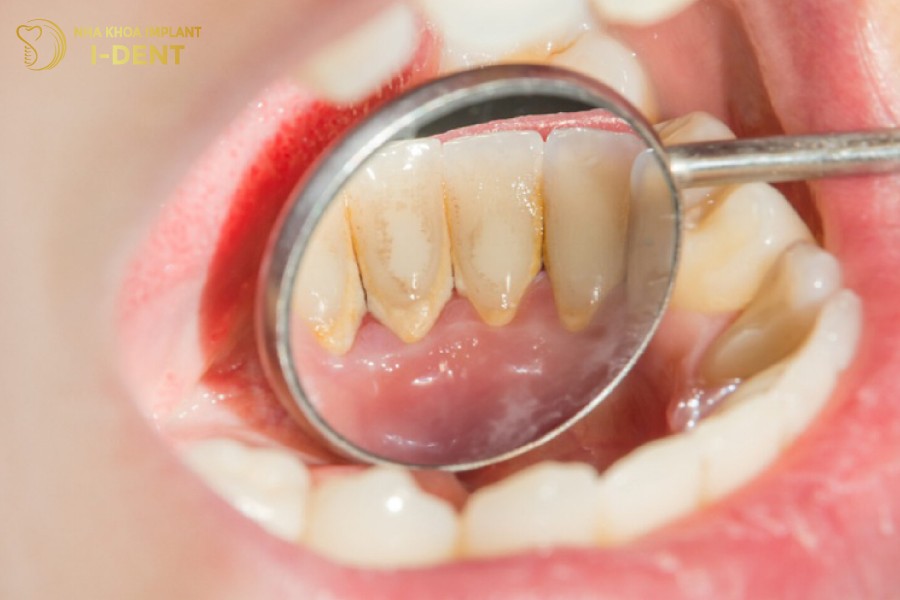 Voi-rang-tich-tu-lau-ngay-se-gay-ra-nhieu-van-de-rang-mieng