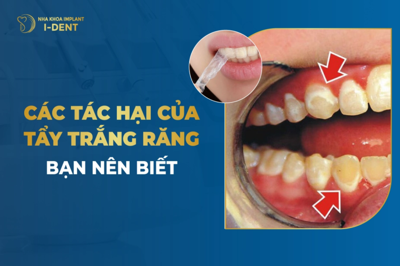 6 Tác hại của tẩy trắng răng cần biết trước khi quyết định làm