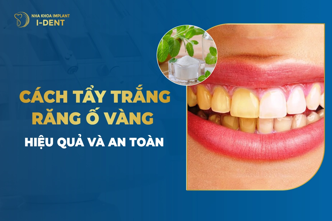 Cách Tẩy Trắng Răng Ố Vàng Hiệu Quả Và An Toàn