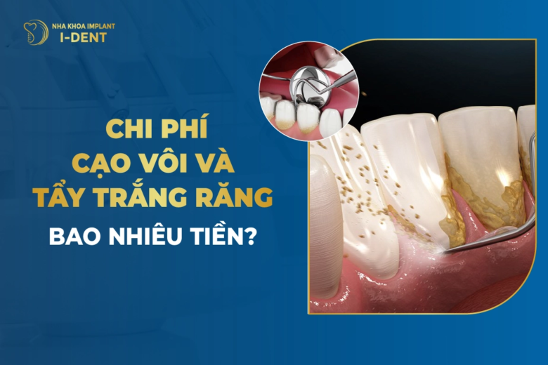 Chi Phí Cạo Vôi Và Tẩy Trắng Răng Bao Nhiêu Tiền?