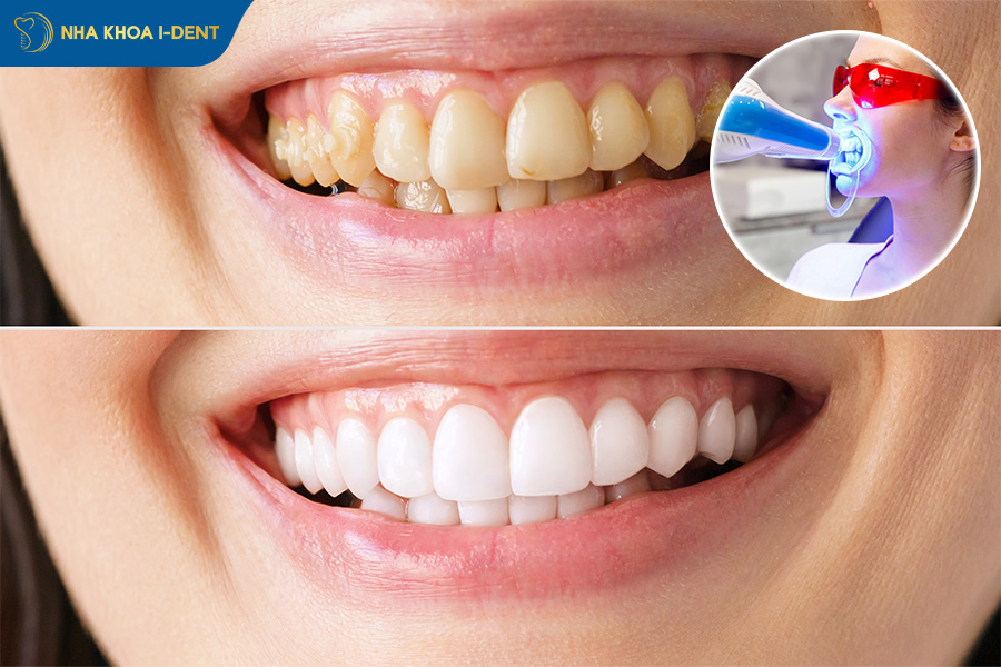 tẩy trắng răng bằng laser giá bao nhiêu
