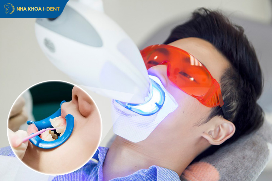 tẩy trắng răng laser