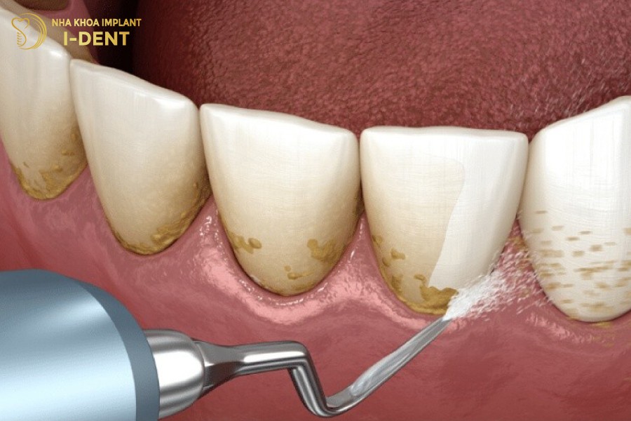 Cao-voi-rang-la-phuong-phap-pho-bien-de-dieu-tri-tut-loi-muc-do-nhe