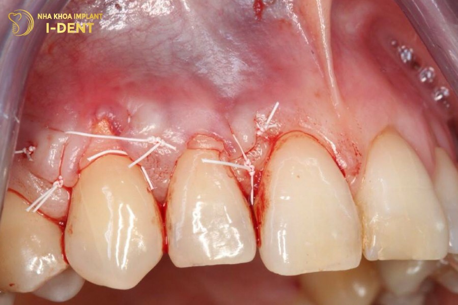 Ghep-vat-loi-de-bu-dap-phan-loi-bi-khuyet-thieu