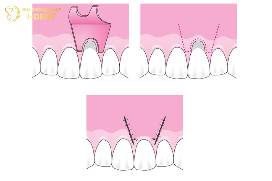 Ghep-vat-loi-giup-tai-tao-tham-my-chuc-nang-cua-vung-rang-bi-tut-loi