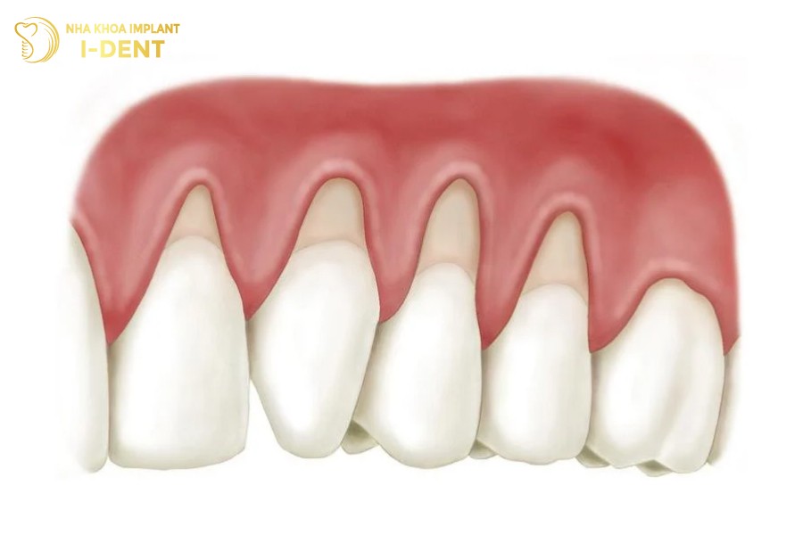 Ho-nuou-chan-rang-la-mot-benh-ly-nguy-hiem