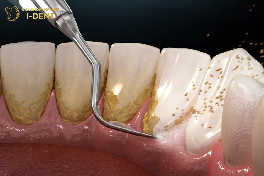 Nen-dinh-ky-lay-cao-rang-6-thang-lan-de-dam-bao-suc-khoe-rang-mieng