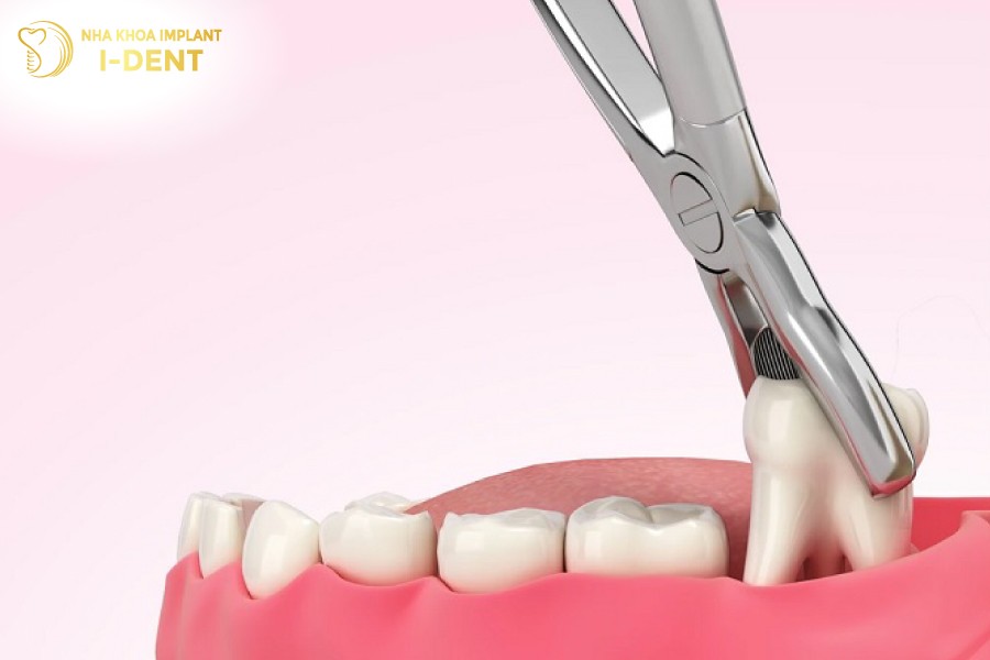 Nho-rang-khon-khi-vua-moi-moc-se-it-gay-dau-nhuc-hon