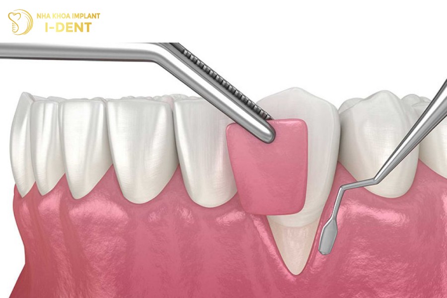 Phau-thuat-ghep-vat-loi-bu-dap-phan-nuou-bi-thieu-hut-khoi-phuc-chuc-nang-nhai