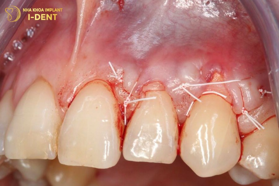 Phau-thuat-ghep-vat-loi-khi-mo-nuou-da-bi-teo-di-qua-nhieu