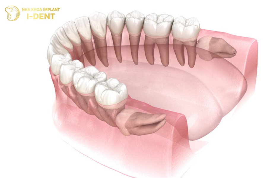 Rang-khon-moc-ngang-gay-xo-lech-ham-rang