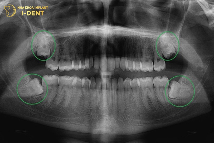 Rang-khon-moc-o-dau-khi-nao